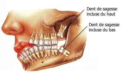 Extraction dentaire : quand, durée, déroulé, soins après